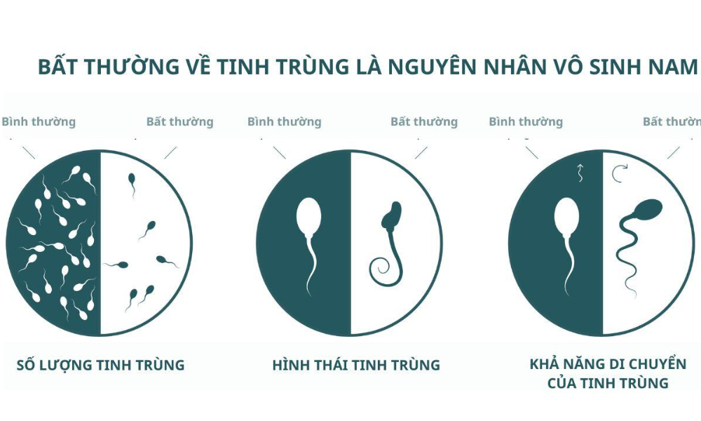 Tuyến tiền liệt bệnh lý có thể tác động trực tiếp đến sinh lý và sinh sản nam giới